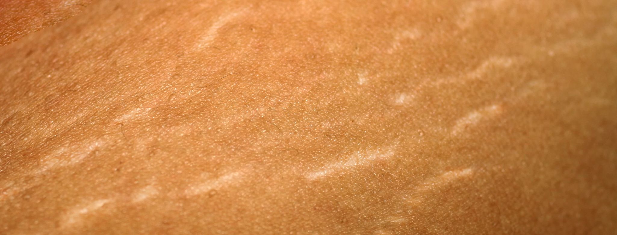 Bílé strie na stehnech