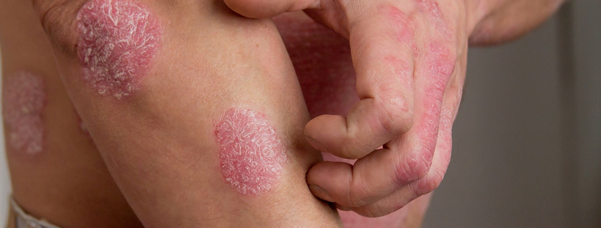 Ložiska lupénky po těle