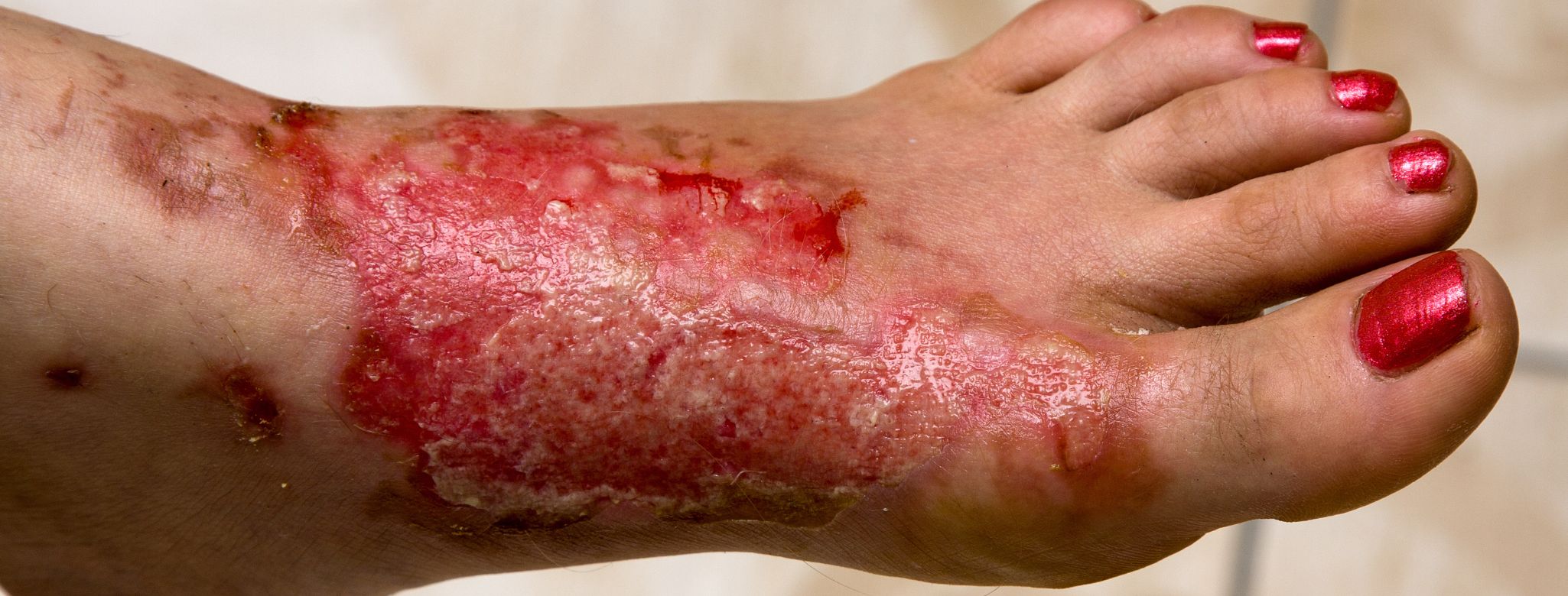 Popálená noha od vody