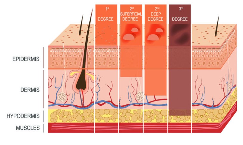 Stupně popálenin
