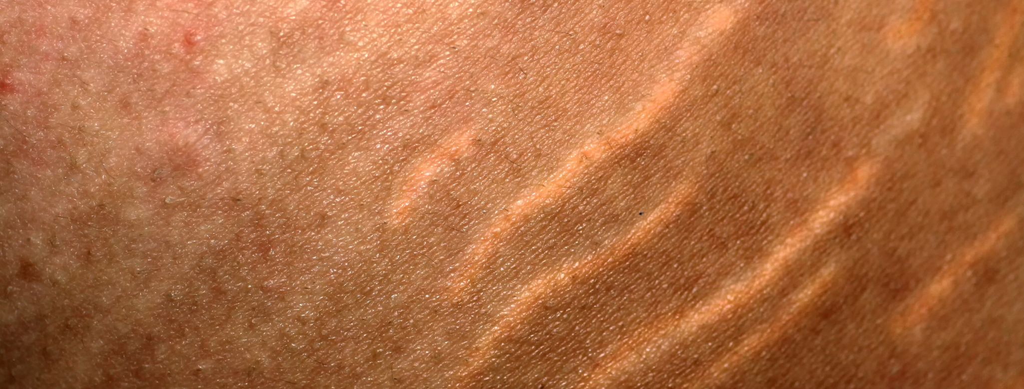 Vystouplé strie na stehnech