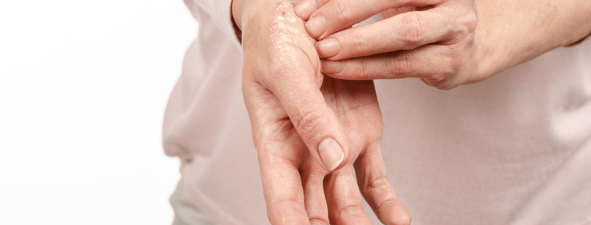 Jak vypadá lupénka a lze jí léčit bambuckým máslem?